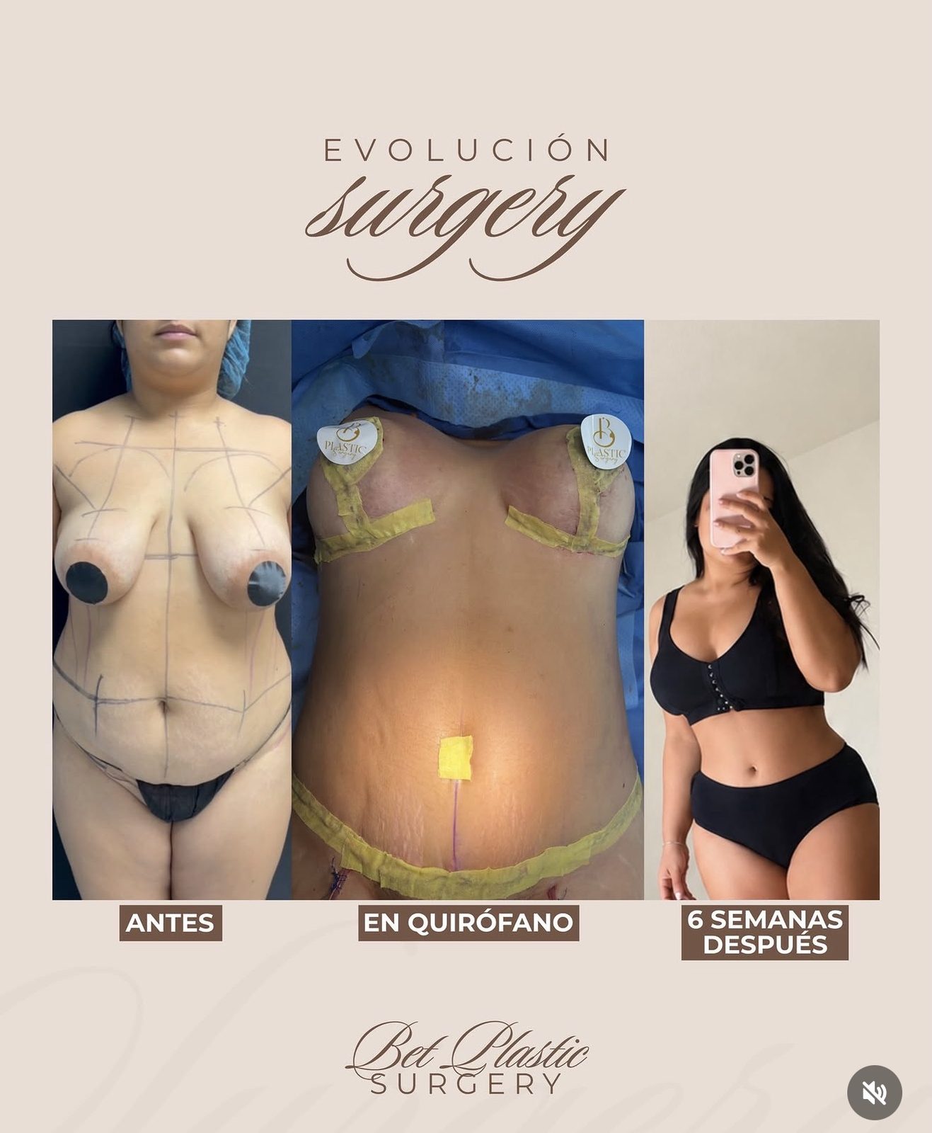 Resultado real de paciente de Dr. Mel Ortega en BET Aesthetics Center