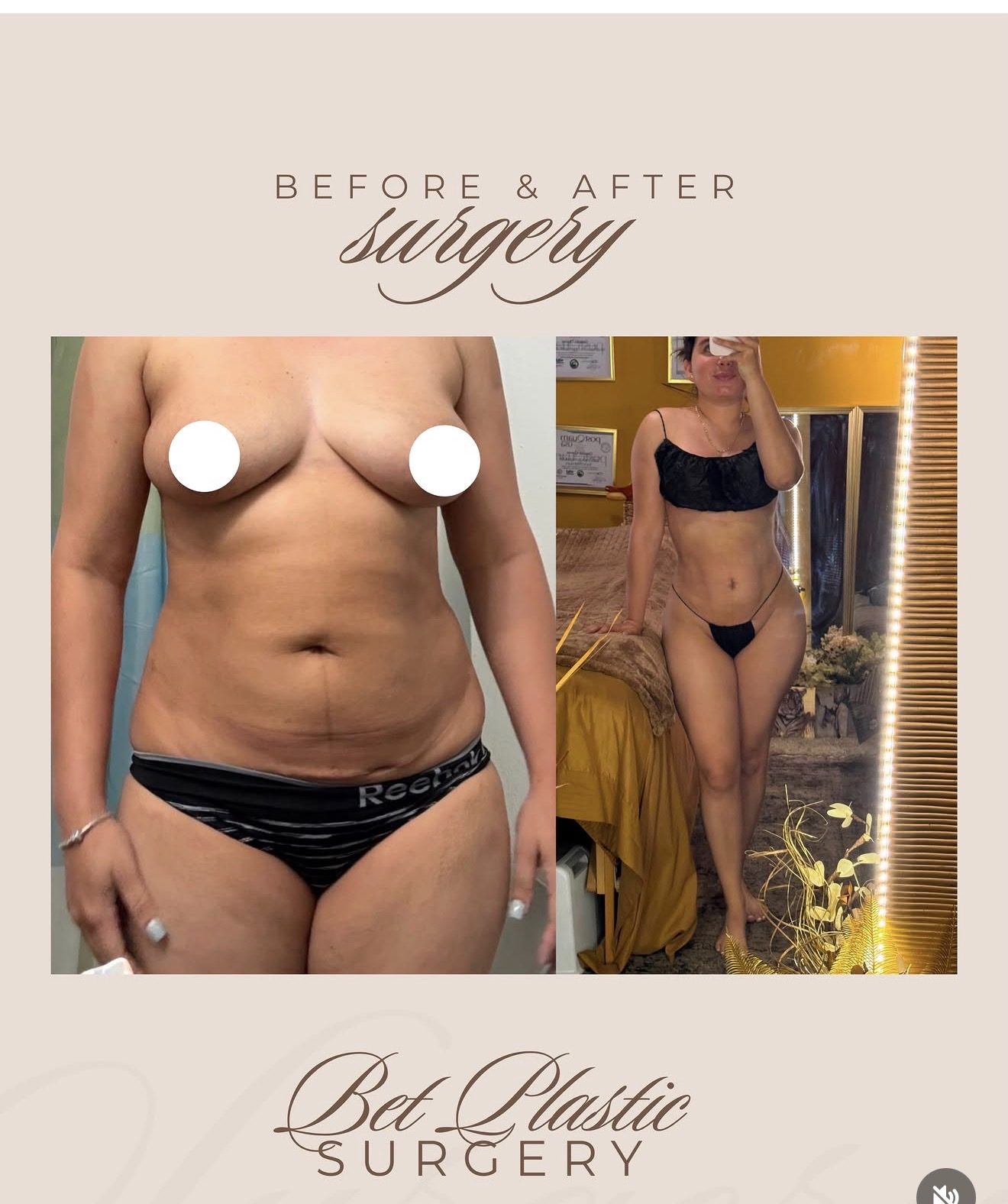Resultado real de paciente de Dr. Mel Ortega en BET Aesthetics Center