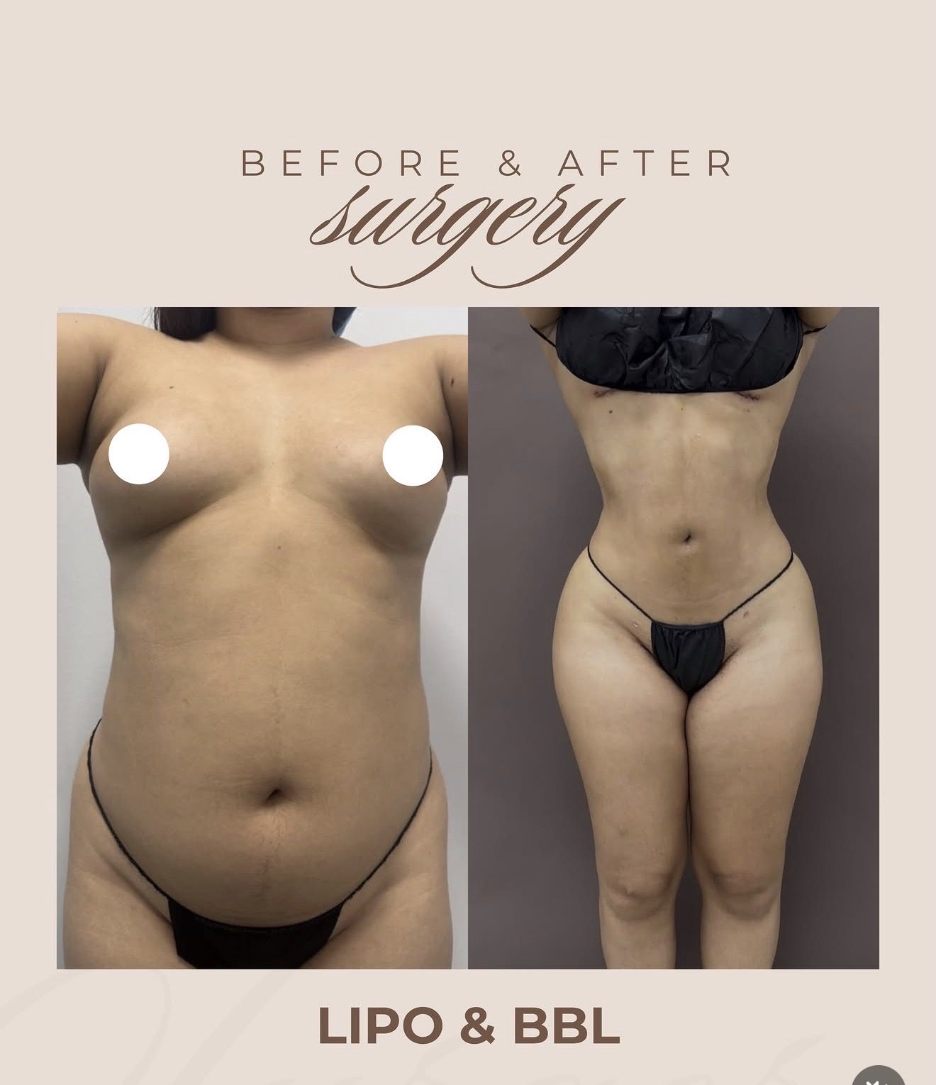 Resultado real de paciente de Dr. Mel Ortega en BET Aesthetics Center