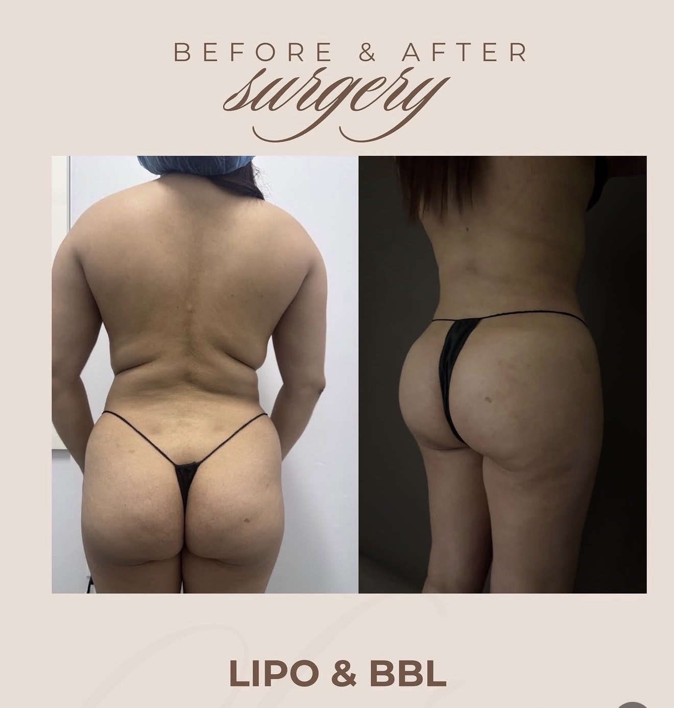 Resultado real de paciente de Dr. Mel Ortega en BET Aesthetics Center