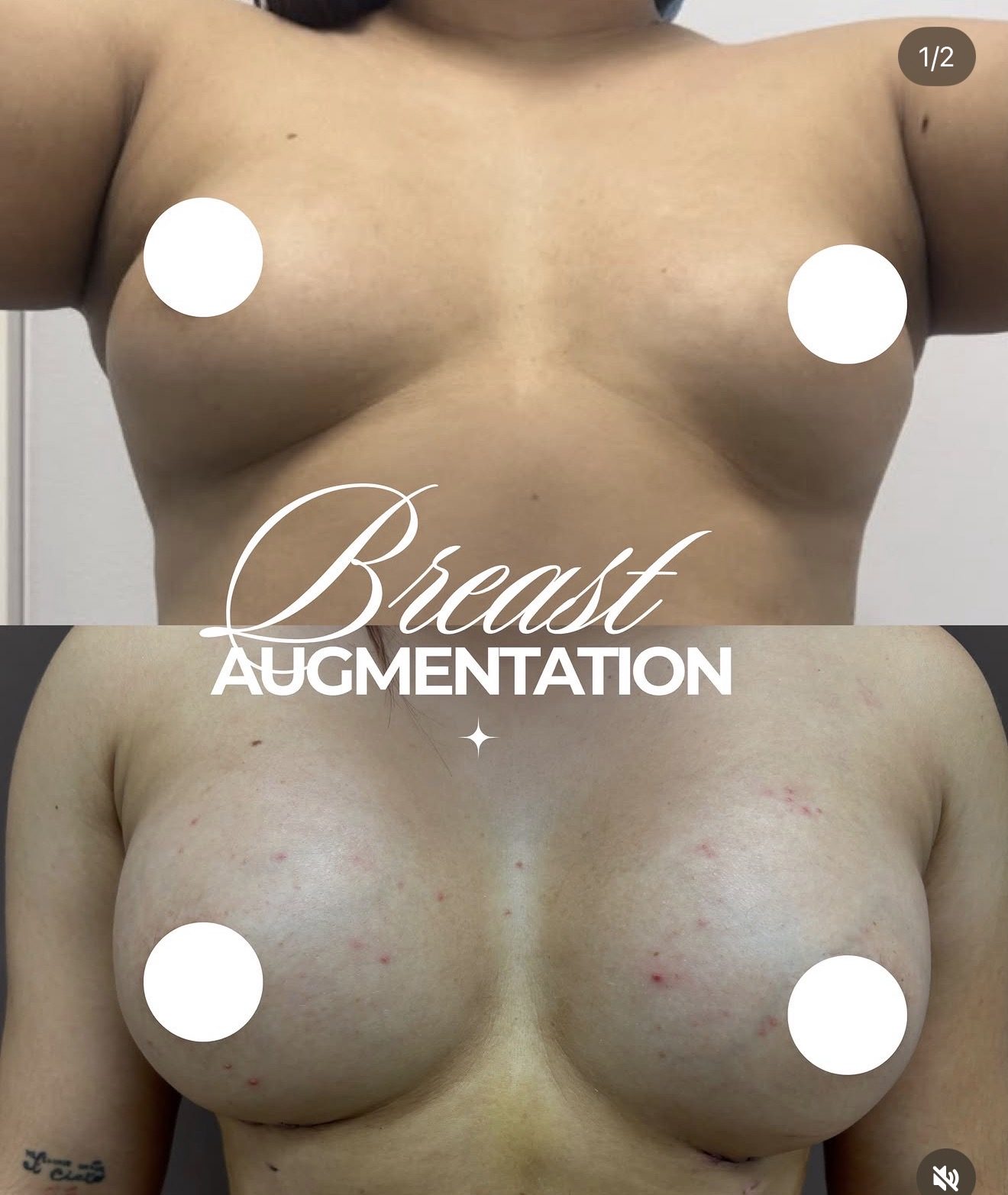 Resultado real de paciente de Dr. Mel Ortega en BET Aesthetics Center