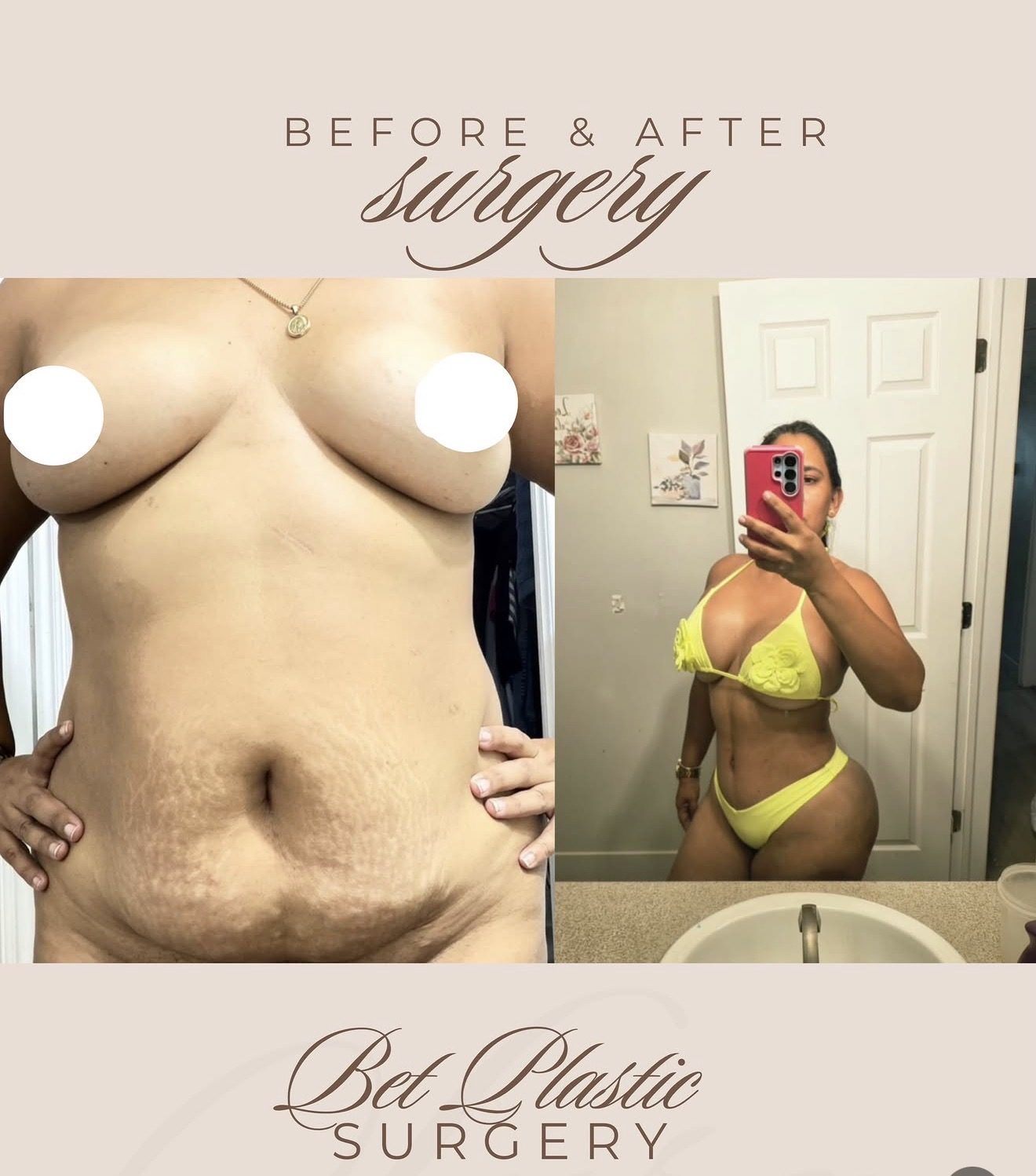 Resultado real de paciente de Dr. Mel Ortega en BET Aesthetics Center
