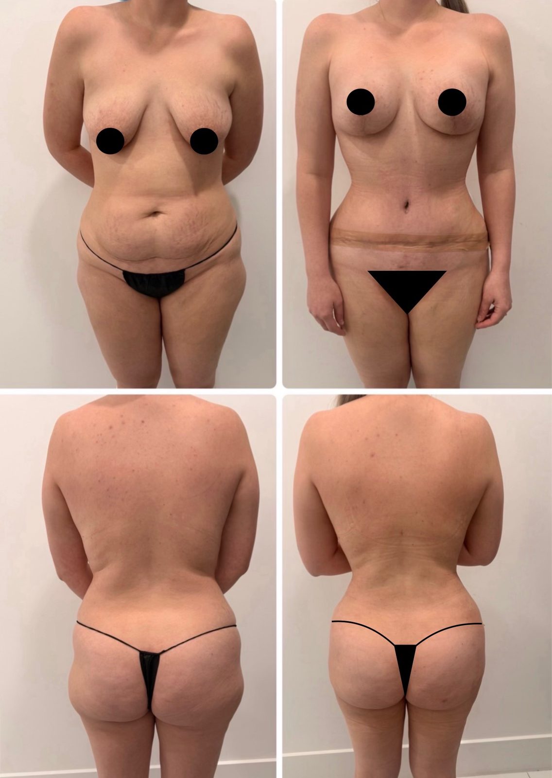 Resultado real de paciente de Dr. Felippe Sartorato en BET Aesthetics Center