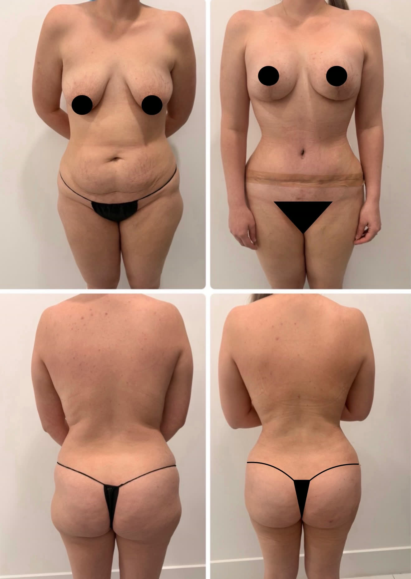 Mommy makeover — antes y después