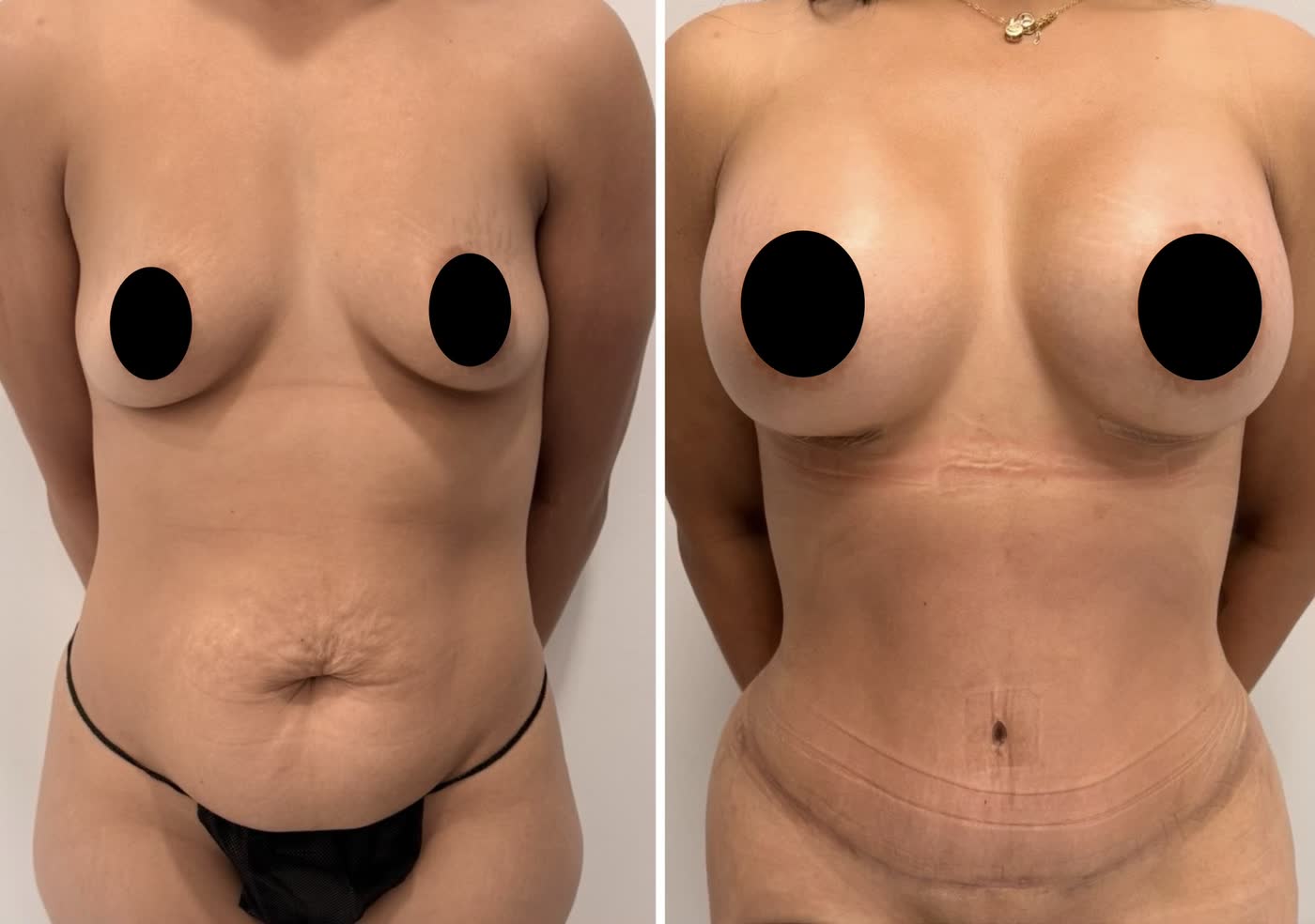 Mommy makeover — antes y después
