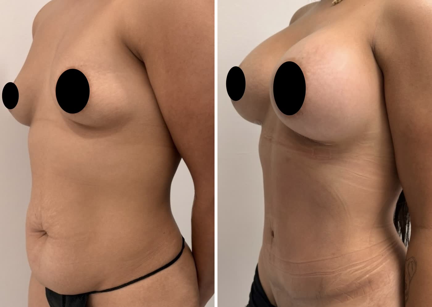 Mommy makeover — antes y después