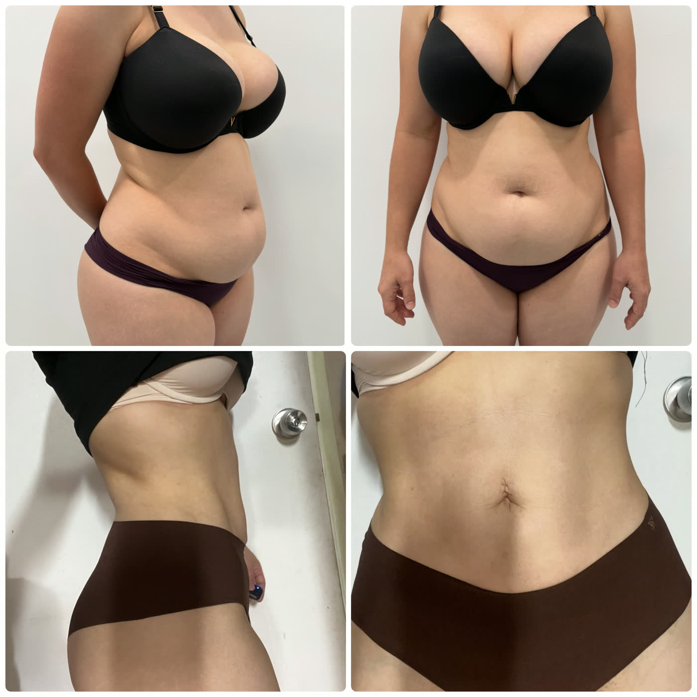 Tummy tuck y Lipo 360 — antes y después