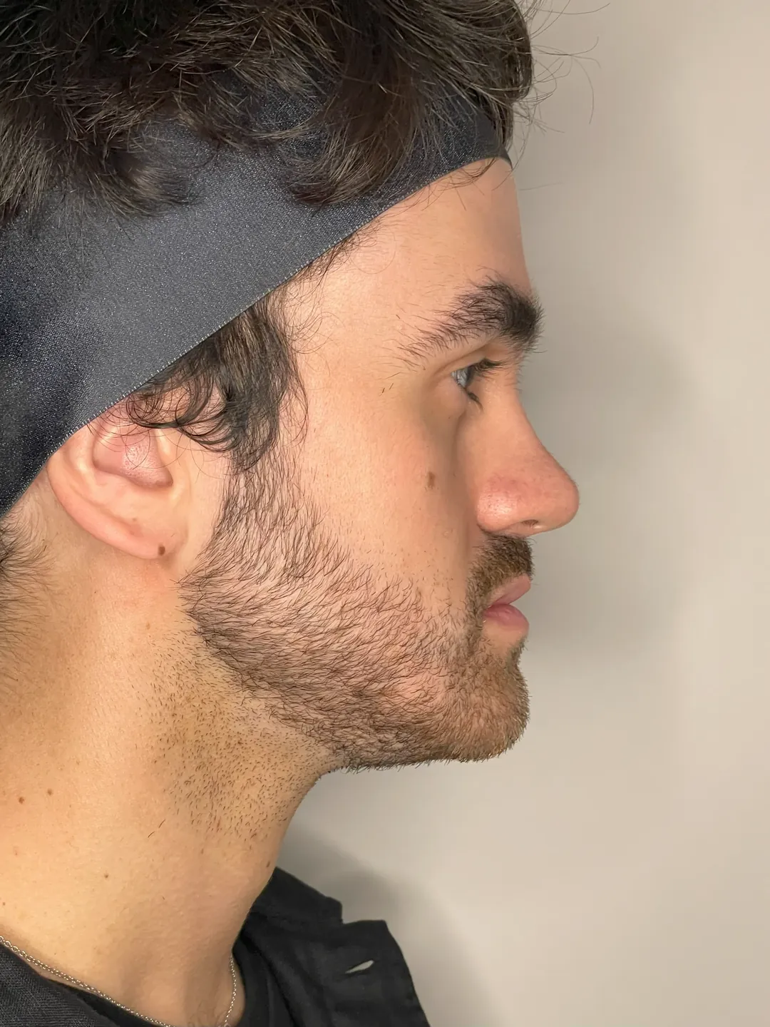 Antes del tratamiento Armonización Facial