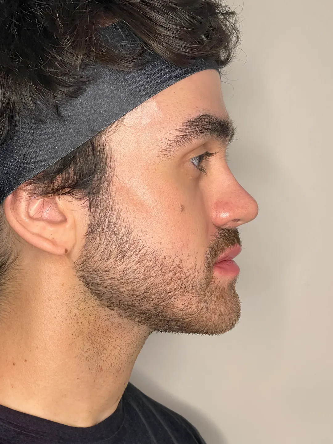 Resultado de Armonización Facial en Clínica Fercasy