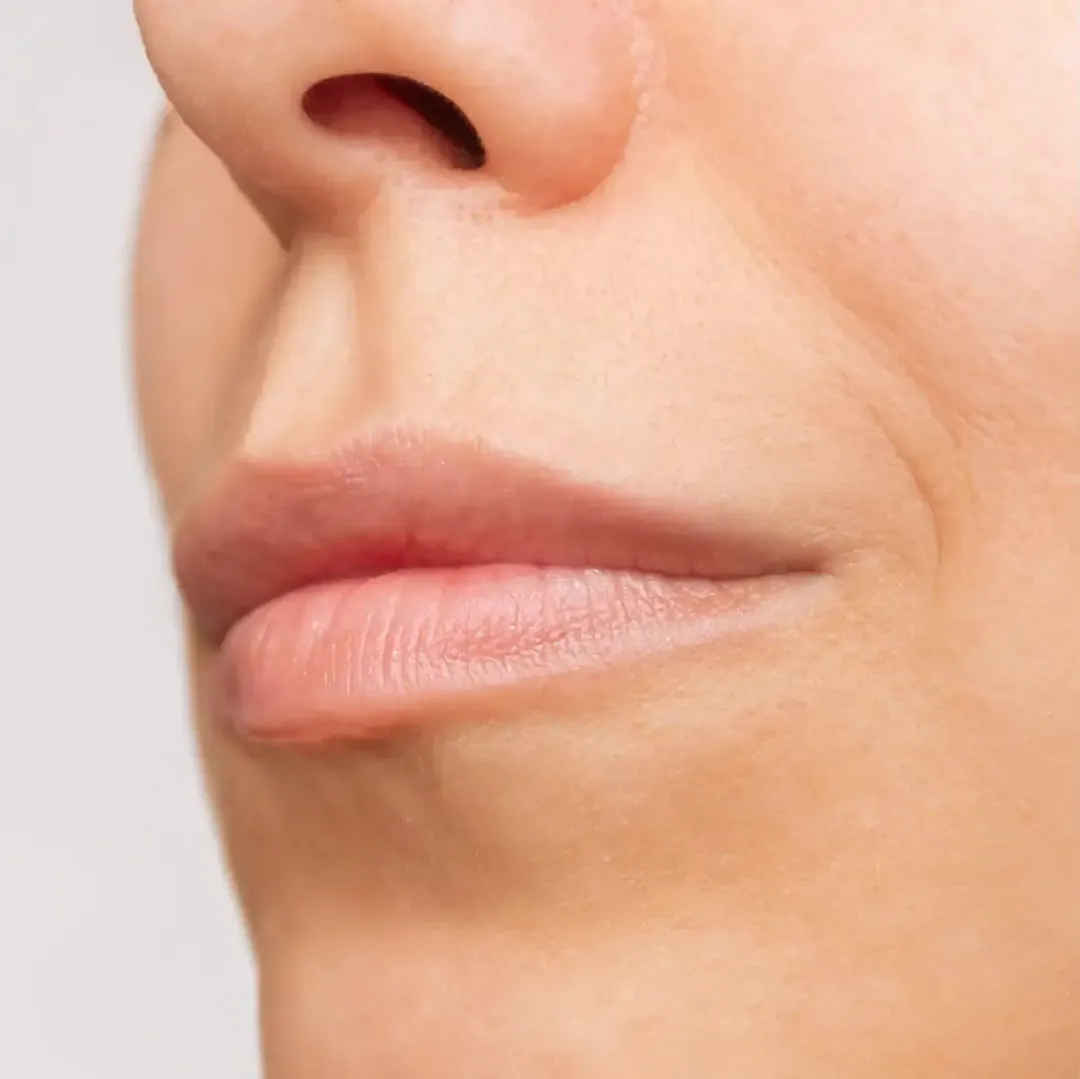 Antes del tratamiento Aumento de Labios
