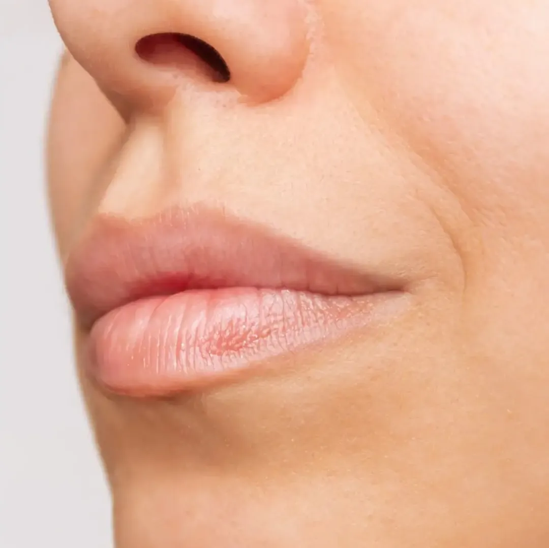 Resultado de Aumento de Labios en Clínica Fercasy
