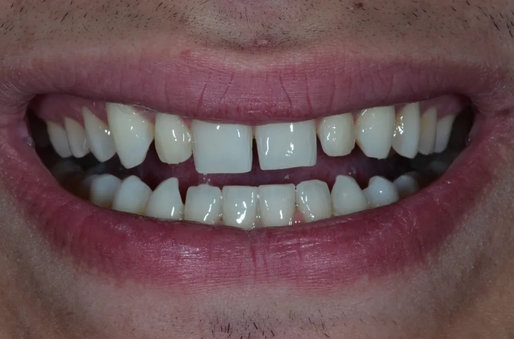 Antes: sonrisa con espacio entre los dientes de adelante