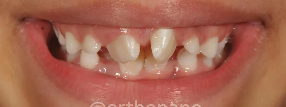 Antes: sonrisa con dientes de leche y espacios