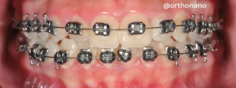 Durante: dientes con brackets